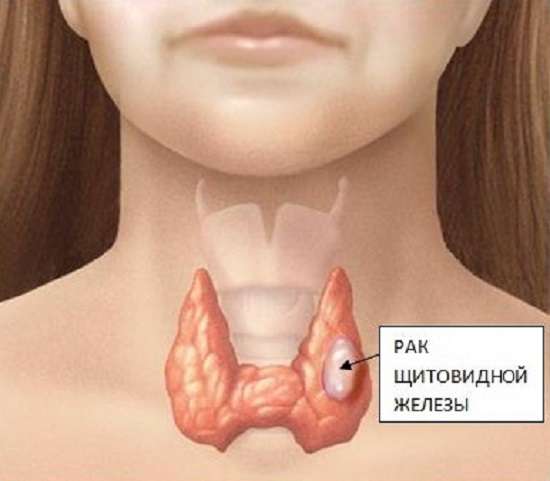 Рак щитовидної залози: симптоми і лікування