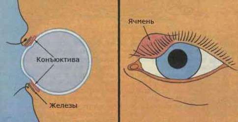 Ячмінь на оці: симптоми і лікування