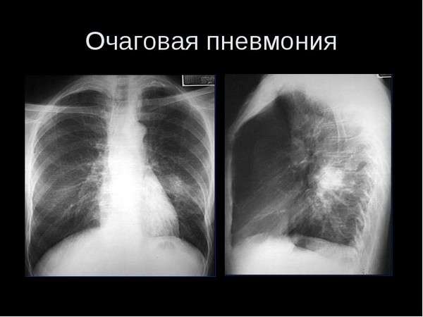 Запалення легенів: симптоми і лікування