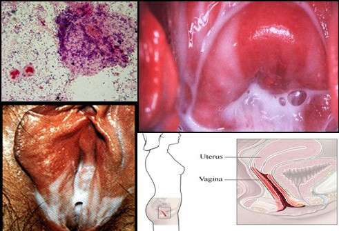 Бактеріальний вагініт: симптоми і лікування