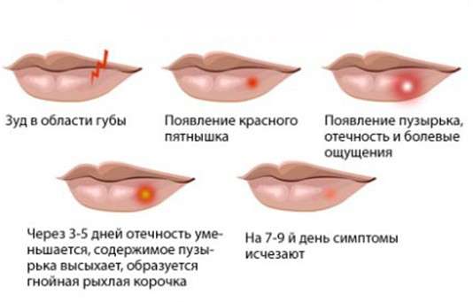 Герпес на губах: симптоми і лікування