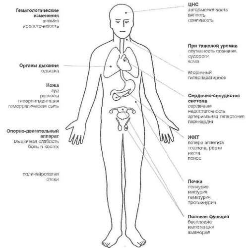 Хронічна ниркова недостатність: симптоми і лікування