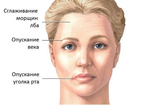 Парез лицьового нерва: симптоми і лікування