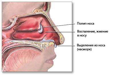 Поліпи носа: симптоми і лікування