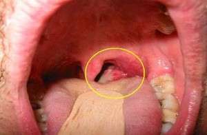 Рак кореня язика: симптоми і лікування