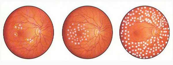 Діабетична ретинопатія: симптоми і лікування