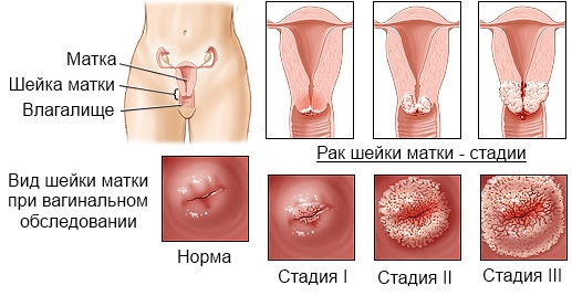 Рак матки: симптоми і лікування