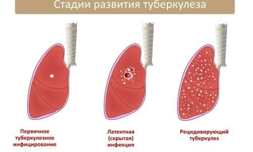 Туберкульоз легенів: симптоми і лікування