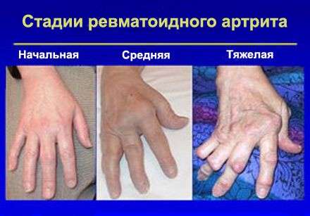 Артрит пальців рук: симптоми і лікування