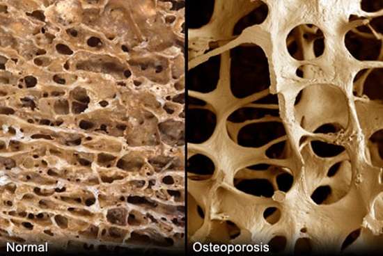 Остеопороз: симптоми і лікування