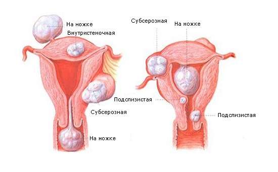 Фіброма матки: симптоми і лікування