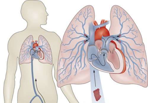 Тромбоемболія легеневої артерії: симптоми і лікування