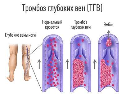 Тромбоз: симптоми і лікування