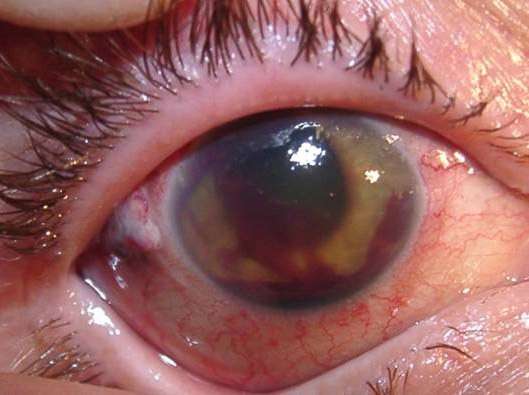 Туберкульоз очей: симптоми і лікування