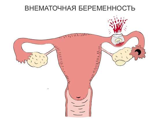 Позаматкова вагітність: симптоми і лікування