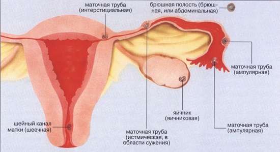 Позаматкова вагітність: симптоми і лікування