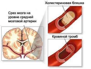 Ішемічна хвороба головного мозку: симптоми і лікування