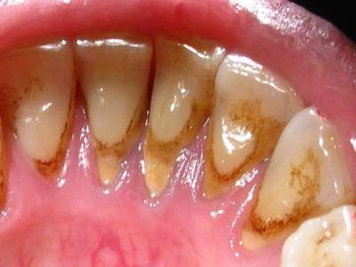 Зубний камінь: симптоми і лікування