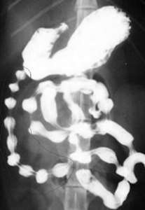 Контрастная рентгенограмма желудка