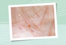 Локалізований пустульозний псоріаз: розуміння симптомів, причин та лікування