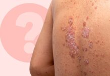 Розвінчання міфів про псоріаз: відокремлення фактів від вигадки