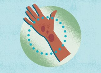 Atopic Dermatitis Disparities: Why Skin of Color is More Affected