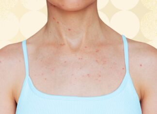 Acné corporelle : où cela se produit et comment le traiter