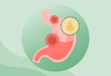 Пептичні Виразки: Розуміння Симптомів, Причин та Ефективного Лікування
