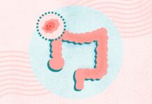 Понимание колоректального рака: профилактика, диагностика и лечение