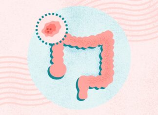 Understanding Colorectal Cancer: Prevention, Detection, and Treatment