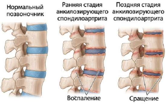 Анкілозуючий спондилоартрит (хвороба Бехтерева): симптоми і лікування