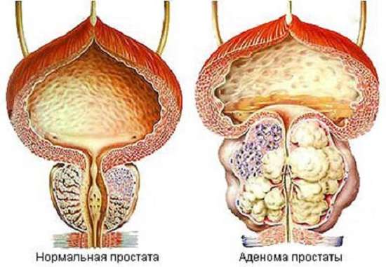 Аденома простати: симптоми і лікування