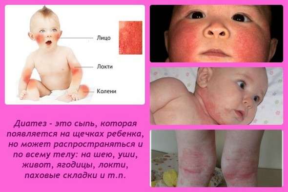 Діатез: симптоми і лікування