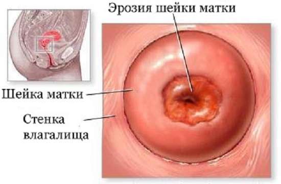 Ерозія шийки матки: симптоми і лікування