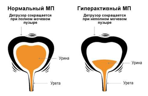 Гіперактивний сечовий міхур: симптоми і лікування