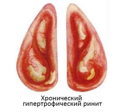 Гіпертрофічний риніт: симптоми і лікування