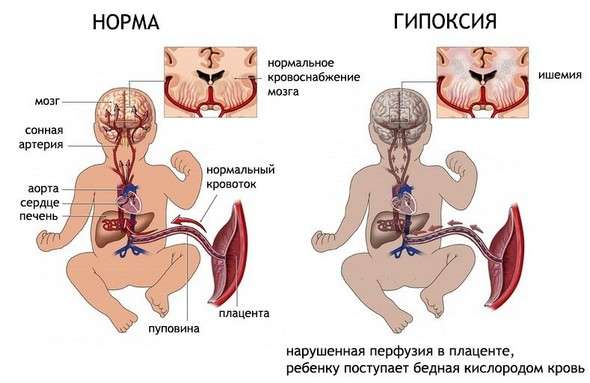 Плацентарна недостатність: симптоми і лікування