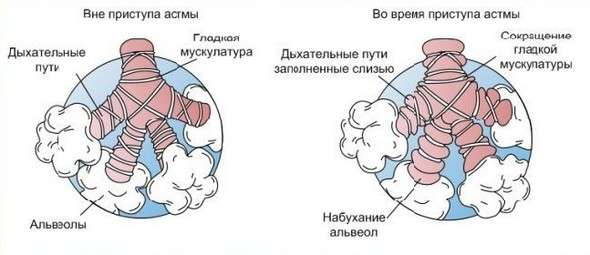 Астматичний кашель: симптоми і лікування