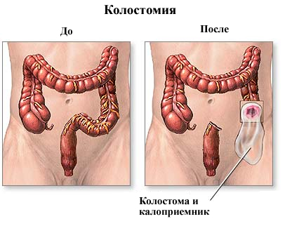 Хвороба Шагаса: симптоми і лікування
