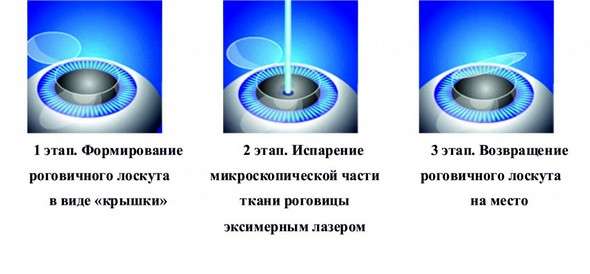 Міопія: симптоми і лікування