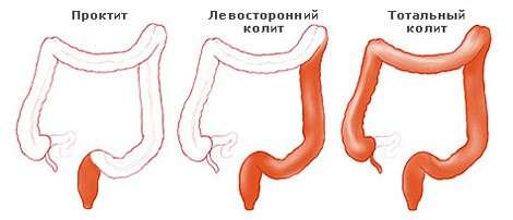 Коліт у дітей: симптоми і лікування