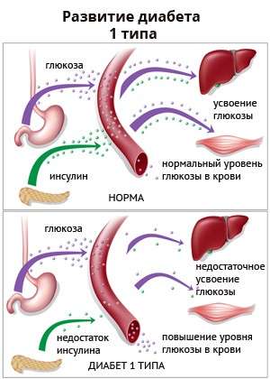 Цукровий діабет 1 типу: симптоми і лікування