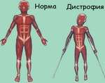 Мязова дистрофія: симптоми і лікування