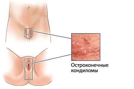 Папіломатоз: симптоми і лікування