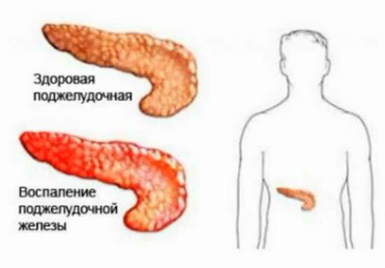 Панкреатит: симптоми і лікування