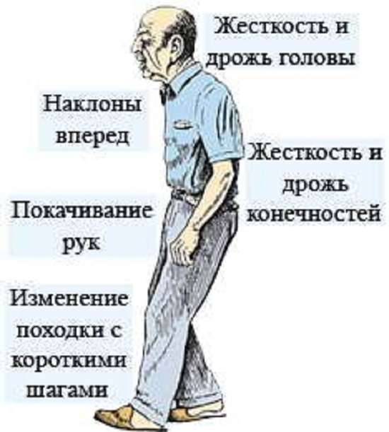 Хвороба Паркінсона: симптоми і лікування