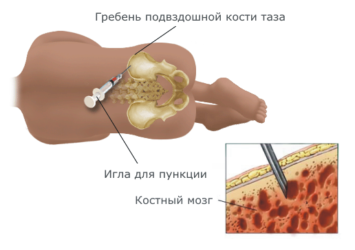 Хвороба Шагаса: симптоми і лікування
