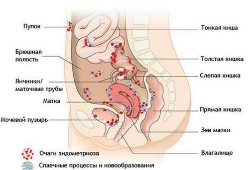 Ендометріоз кишечника: симптоми і лікування