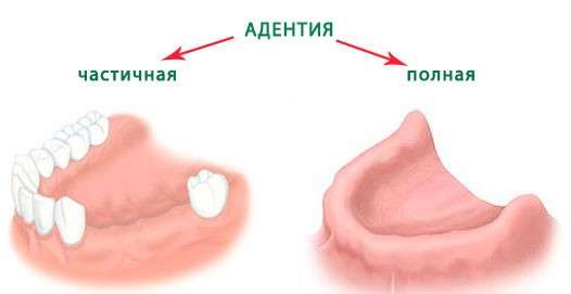 Адентія: симптоми і лікування