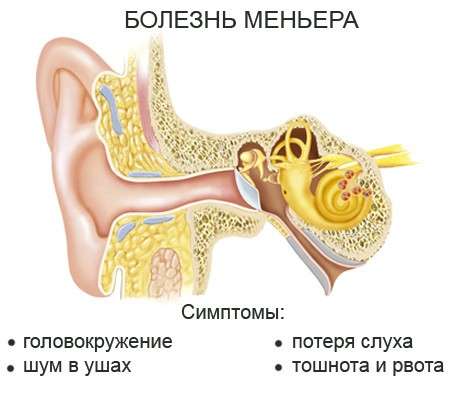 Хвороба Меньєра: симптоми і лікування